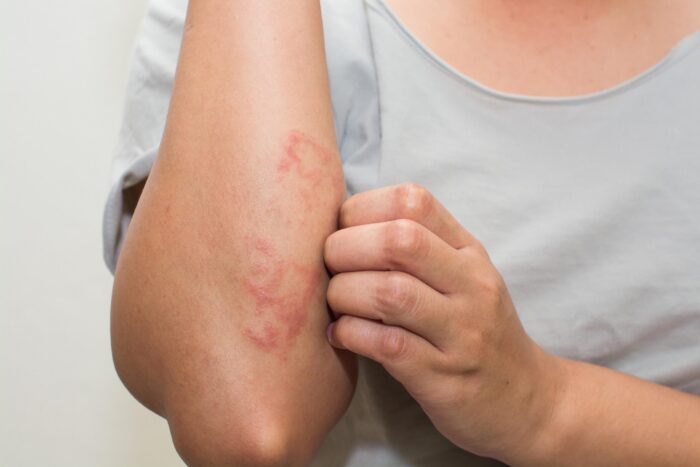 Does Working Out Aggravate or Alleviate Eczema Symptoms