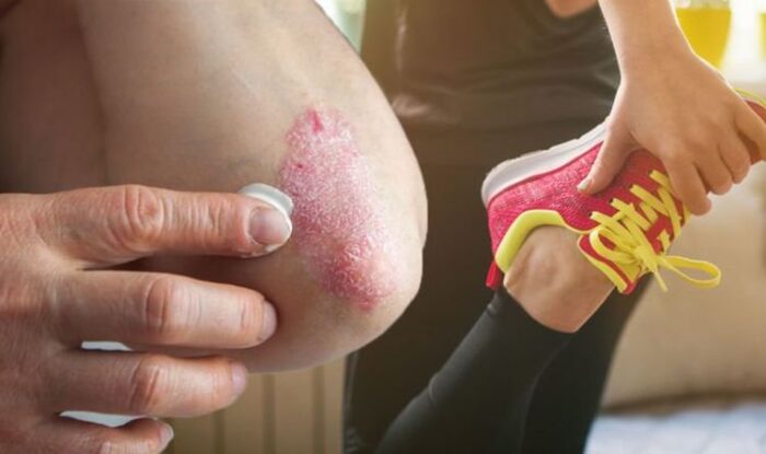 Working Out with Eczema
